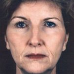 Facelift Before & After Patient #939