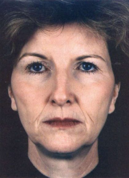 Facelift Before & After Patient #939