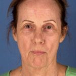 Facelift Before & After Patient #945