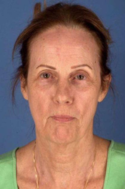 Facelift Before & After Patient #945
