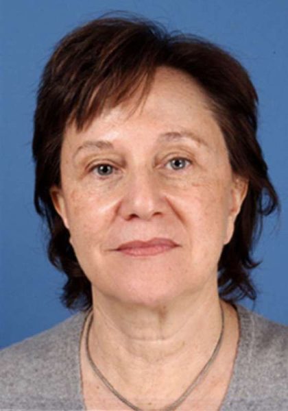 Facelift Before & After Patient #951