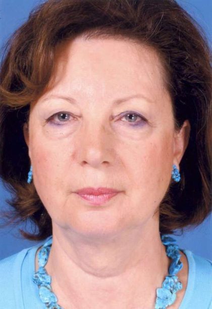 Facelift Before & After Patient #957