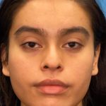 Facial Feminization Before & After Patient #882