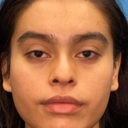 Facial Feminization Before & After Patient #882