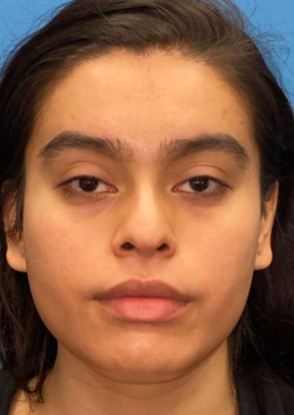 Facial Feminization Before & After Patient #882