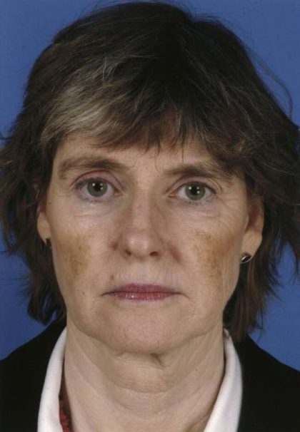 Facelift Before & After Patient #963