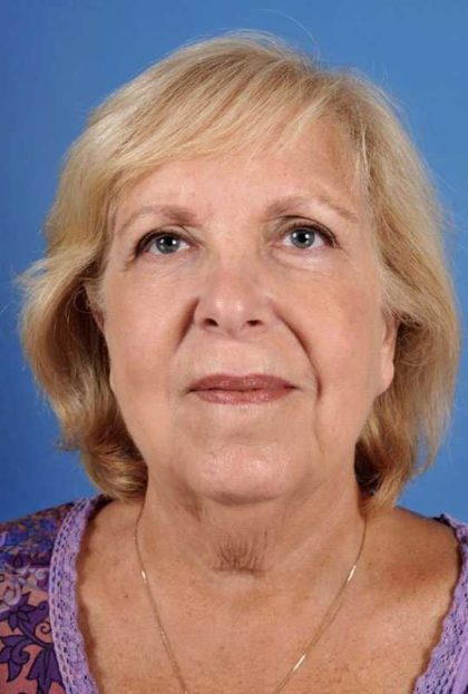 Facelift Before & After Patient #969