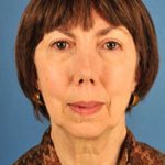 Facelift Before & After Patient #975