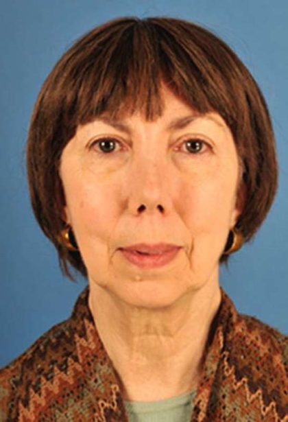 Facelift Before & After Patient #975