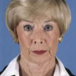 Facelift Before & After Patient #987