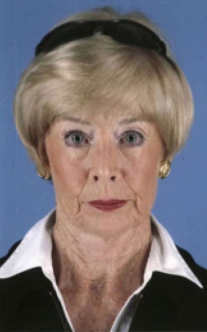 Facelift Before & After Patient #987