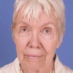 Facelift Before & After Patient #993