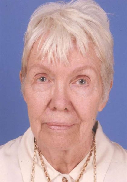 Facelift Before & After Patient #993