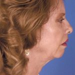 Facelift Before & After Patient #999