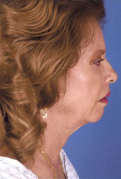 Facelift Before & After Patient #999