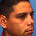 Rhinoplasty Before & After Patient #1005