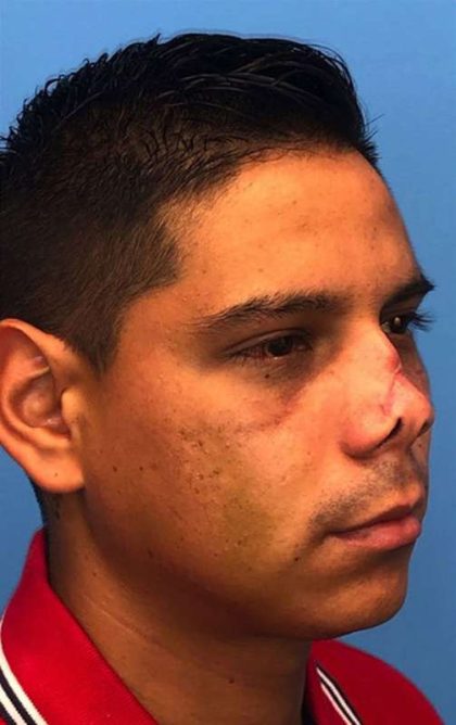 Rhinoplasty Before & After Patient #1005