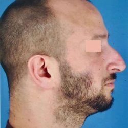 Rhinoplasty Before & After Patient #1017