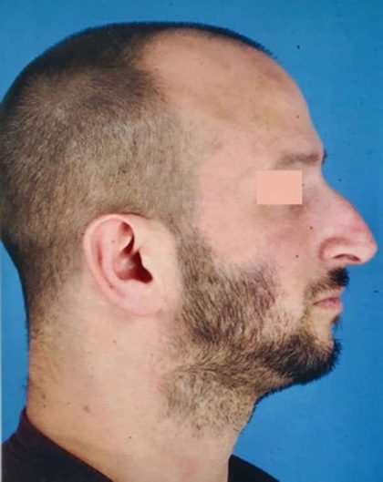 Rhinoplasty Before & After Patient #1017