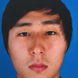 Rhinoplasty Before & After Patient #1023