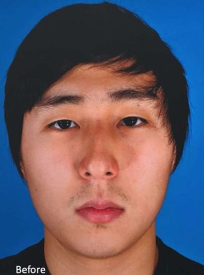 Rhinoplasty Before & After Patient #1023