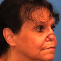 Rhinoplasty Before & After Patient #1026