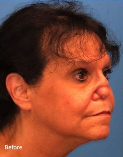 Rhinoplasty Before & After Patient #1026