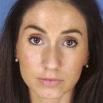 Rhinoplasty Before & After Patient #1032