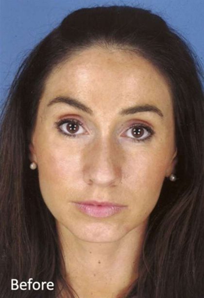 Rhinoplasty Before & After Patient #1032
