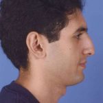 Rhinoplasty Before & After Patient #1047