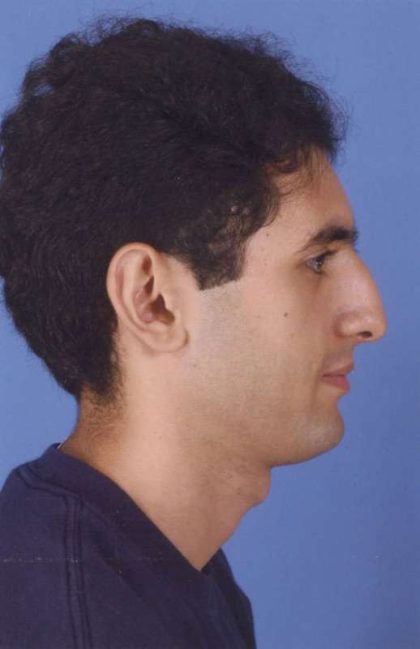 Rhinoplasty Before & After Patient #1047