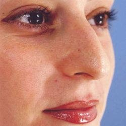 Rhinoplasty Before & After Patient #1050