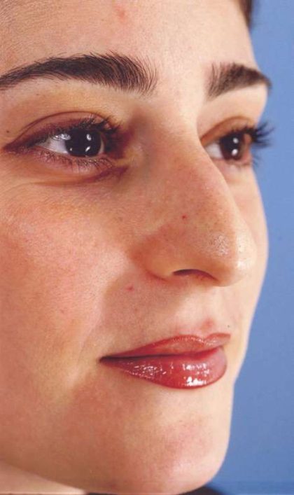 Rhinoplasty Before & After Patient #1050