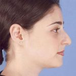 Rhinoplasty Before & After Patient #1053