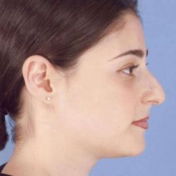 Rhinoplasty Before & After Patient #1053