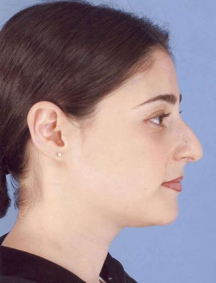 Rhinoplasty Before & After Patient #1053