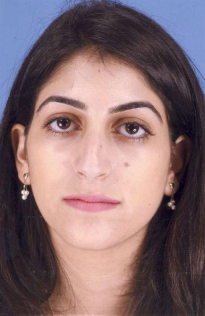 Rhinoplasty Before & After Patient #1059