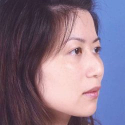 Rhinoplasty Before & After Patient #1065