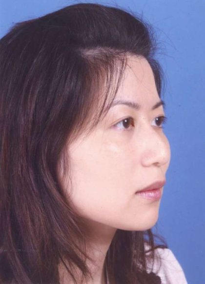Rhinoplasty Before & After Patient #1065
