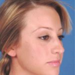 Rhinoplasty Before & After Patient #1077