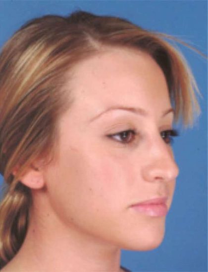 Rhinoplasty Before & After Patient #1077