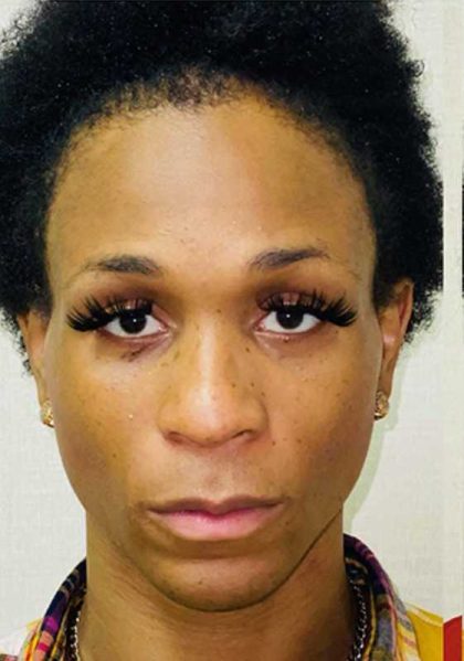 Facial Feminization Before & After Patient #894