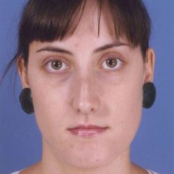Rhinoplasty Before & After Patient #1083