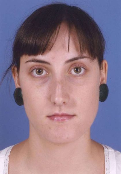 Rhinoplasty Before & After Patient #1083