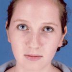 Rhinoplasty Before & After Patient #1092