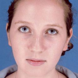 Rhinoplasty Before & After Patient #1092