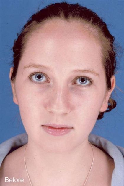 Rhinoplasty Before & After Patient #1092