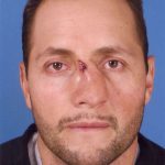 Rhinoplasty Before & After Patient #1098