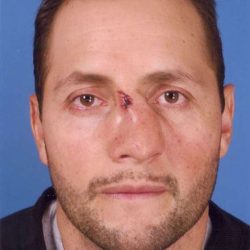 Rhinoplasty Before & After Patient #1098