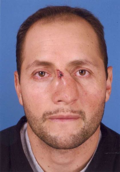 Rhinoplasty Before & After Patient #1098